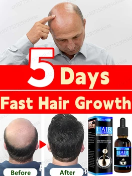 Средство для быстрого роста волос Унисекс От Выпадения волос, Наследственной себорейной алопеции, Масло Для Лечения Эссенции для роста волос
